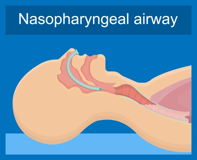 Nasopharyngealer Airway